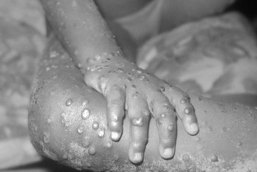  Sud-Kivu : l’épidémie de variole de singe fait un mort et plusieurs autres personnes infectées à Kamituga
