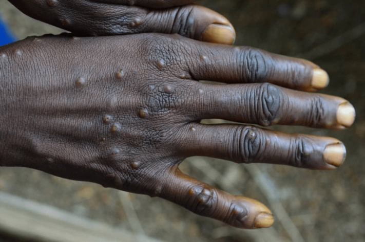  Kwango : 32 cas de Mpox dont un décès notifiés, six zones de santé touchées