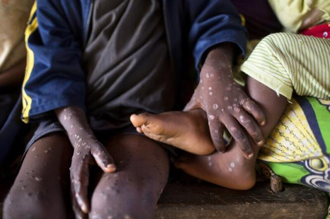  Tshopo : l'épidémie de Mpox touche au moins 27 aires de la zone de santé de Yahuma