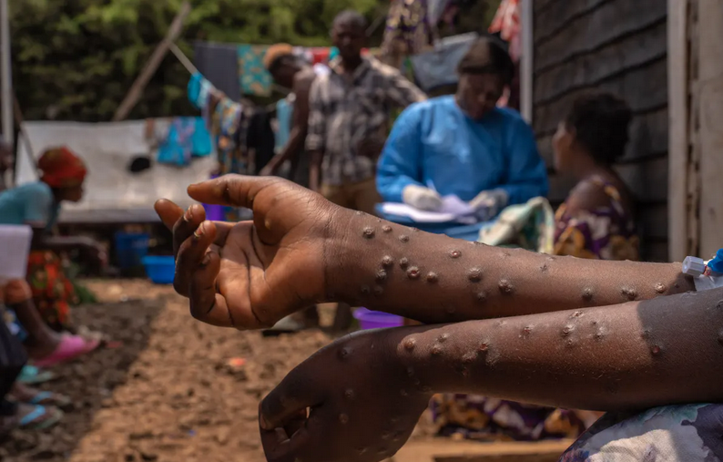  Mpox en RDC : déjà 610 cas de décès signalés en 8 mois