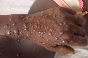 Mpox au Sud-Kivu : plus de 7700 cas et 43 décès enregistrés depuis début 2024